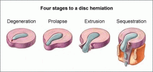 Cervical_Disc_Herniation2